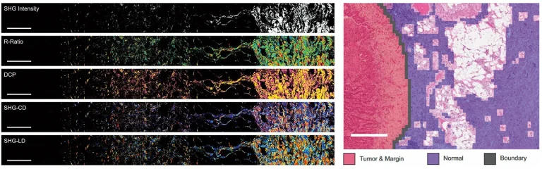 Large-area widefield polarization-resolved SHG microscopy of human lung tissue tumor margin using the PHAROS laser. Image parameters such as SHG intensity, R-ratio, and degree of circular polarization, as well as SHG circular and linear dichroism, are used in unsupervised machine learning to determine the tumor boundary.